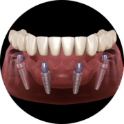 full arch dental implants