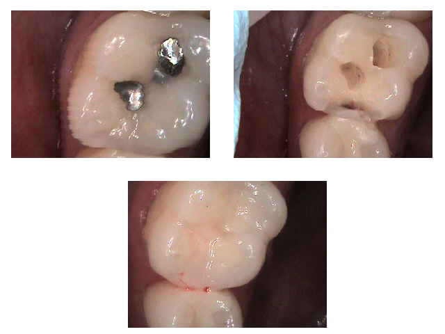 composite filling