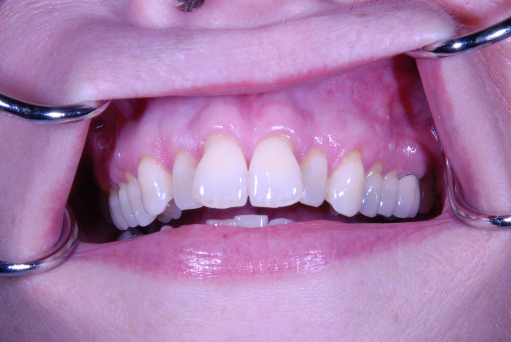 composite filling