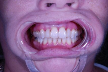 composite filling