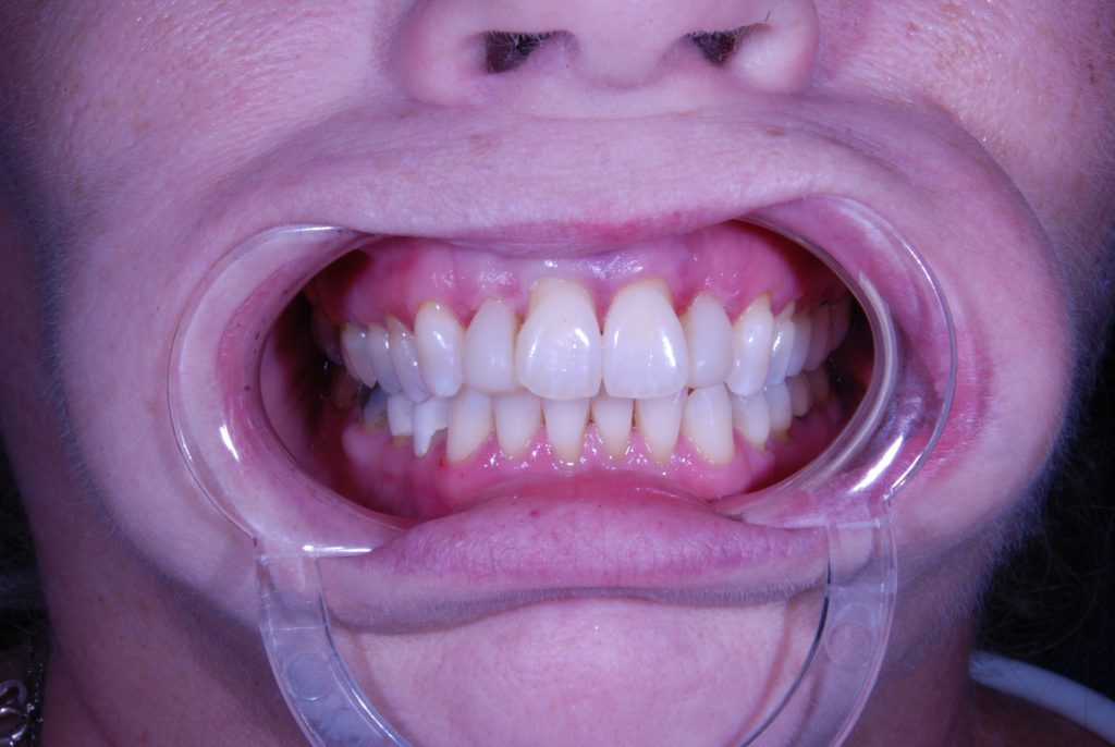 composite filling