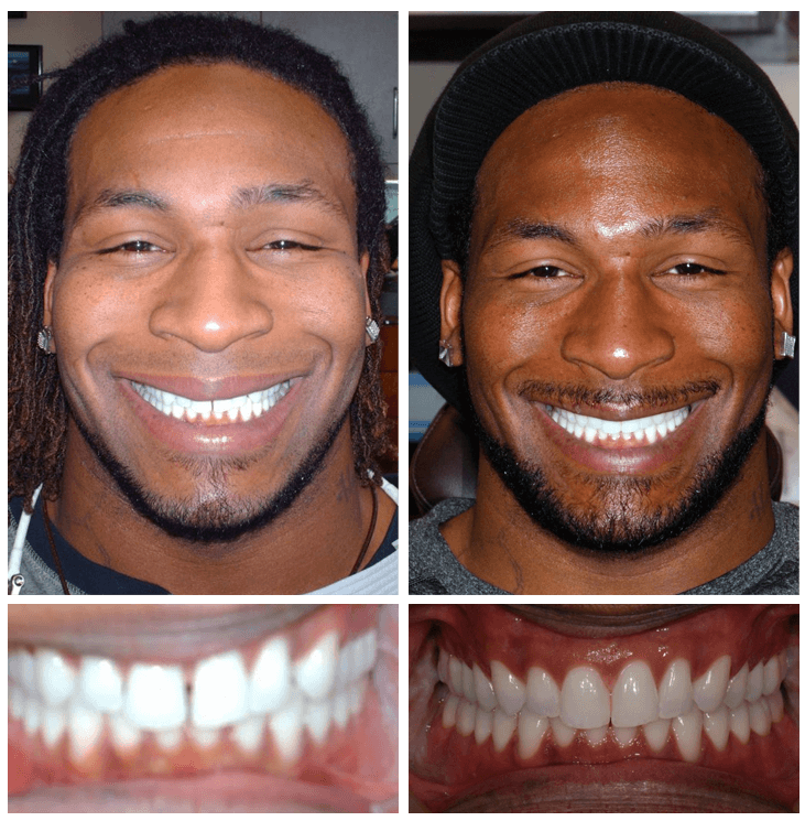 demetrius veal invisalign before and after