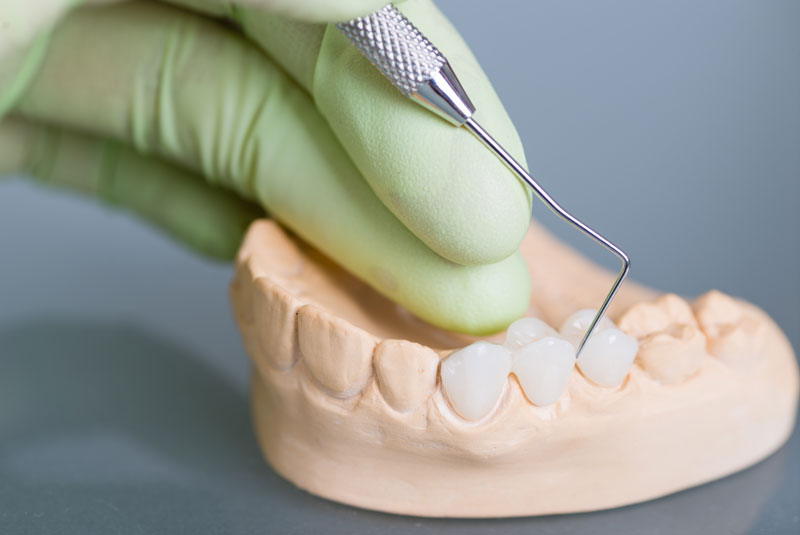 dental bridges model