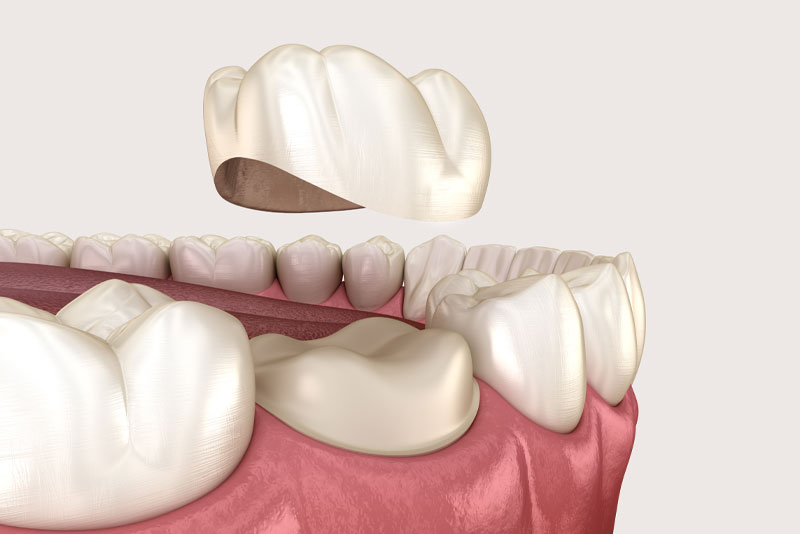 dental crown model