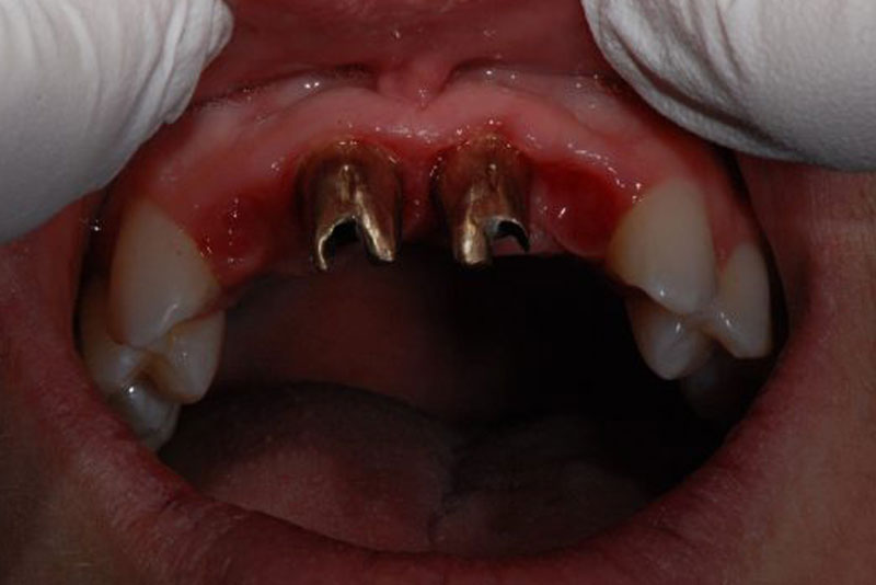 dental implants before