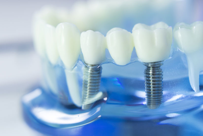 dental implants model