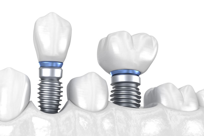 dental implants model
