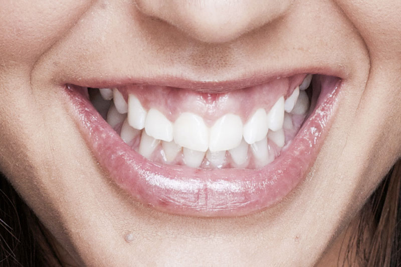 dental patient in need of crown lengthening