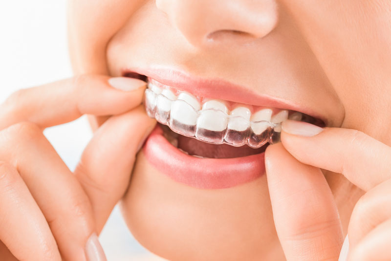 dental patient wearing invisalign