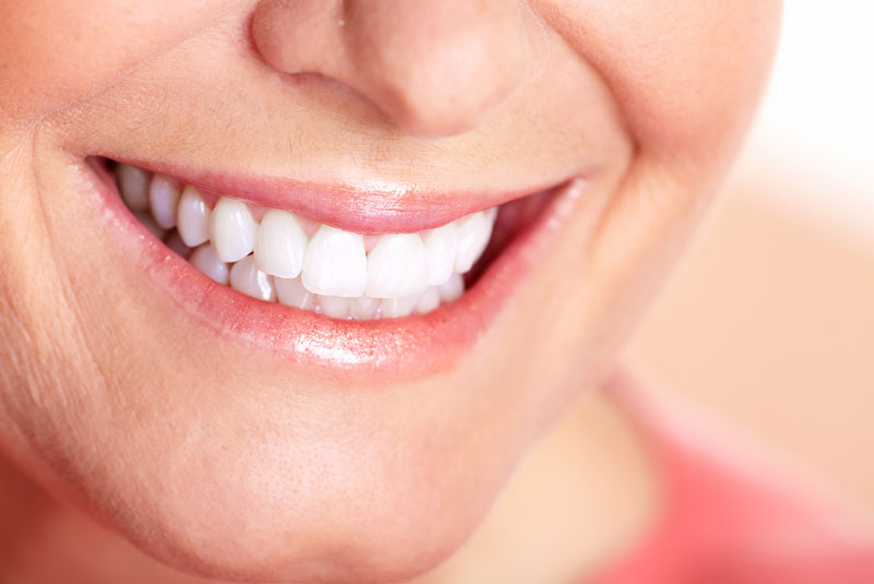 full mouth dental implants patient smiling