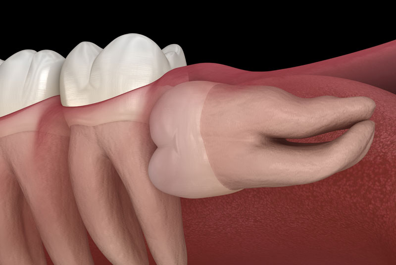 impacted wisdom tooth model