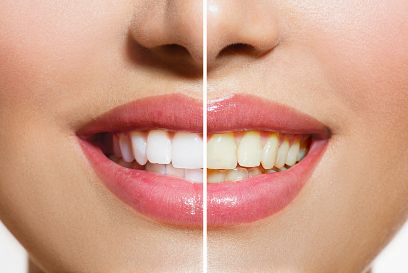 teeth whitening before and after