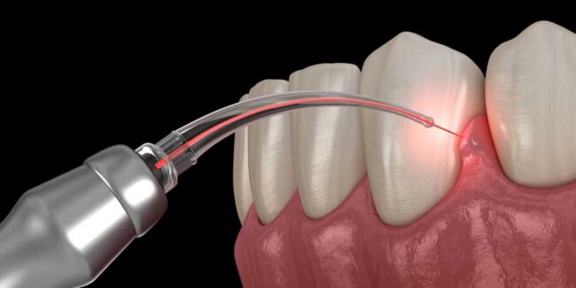 gum-disease-treatment-laser-graphic-opt gum disease treatment