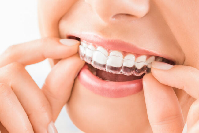 invisalign-patient Taking out Invisalign