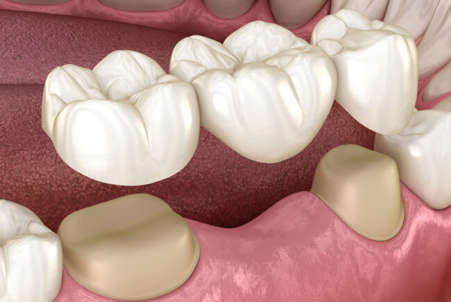 dental-bridge-model 2 Dental Bridge Graphic