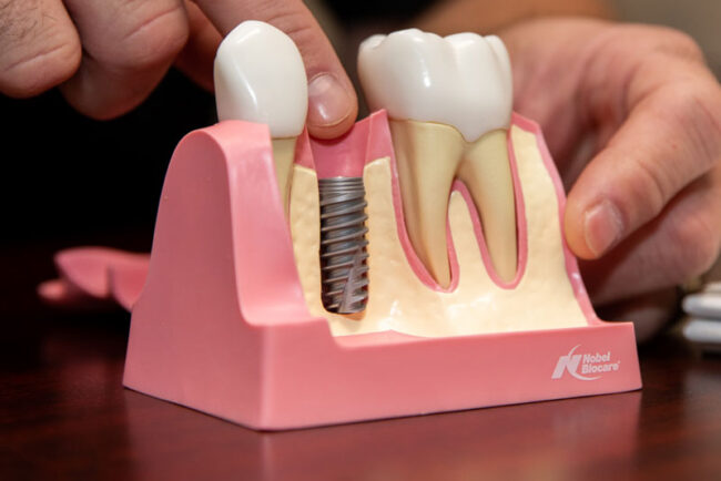dental-implant-model 3 A Dental Implant In Your Bone Model