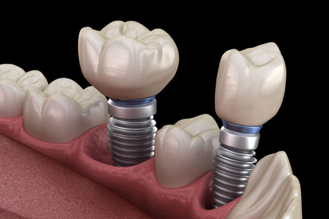 dental-implants-model 2 Dental Implant Model