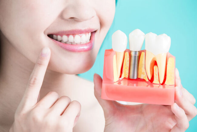 Patient-With-Dental-Implant-Model Patient With Dental Implant Model