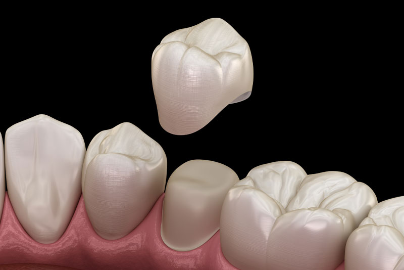 Dental Crown Model Graphic