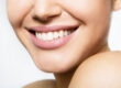 Smile Makeover Patient