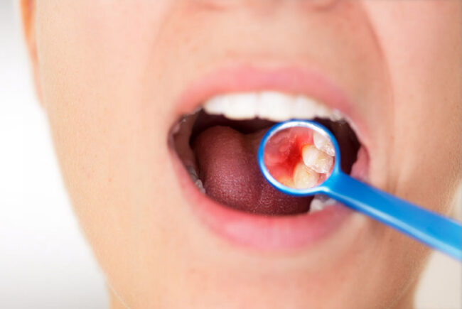 dental-patient-in-need-of-periodontal-treatment-1 Dental Patient Needing Periodontal Treatment