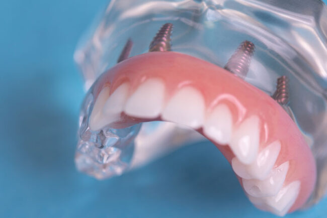 full-arch-dental-implants-model Full Arch Dental Implant Model