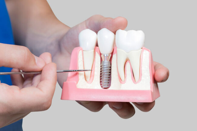 dental-implant-model-bone-cutaway-4 Dental Assistant Showing Off A Dental Implant In A Jawbone Cutaway Model in Westminster, CO