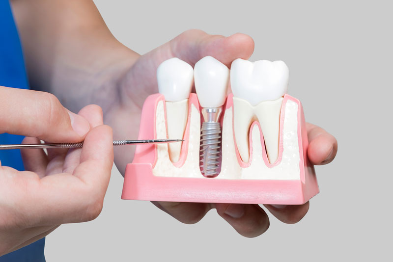 Dental Assistant Showing Off A Dental Implant In A Jawbone Cutaway Model in Westminster, CO