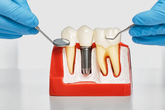 dental-implant-model-bone-cutaway-3 A dental implant model bone cutaway showing Osseointegration