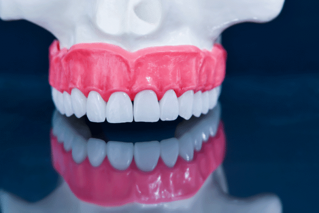 all-on-4-dental-implant-model-x an all-on-4 dental implant model showing a full arch restoration