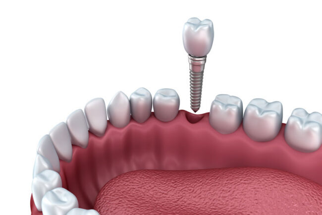 Dental-Implant-Model-3 a single dental implant and post being placed into a lower jaw
