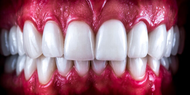 full-mouth-dental-implants-in-mouth a set of full mouth dental implants after placement