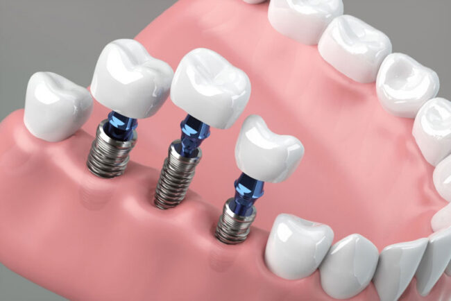three-single-dental-implants three single dental implants being placed into a jaw model.