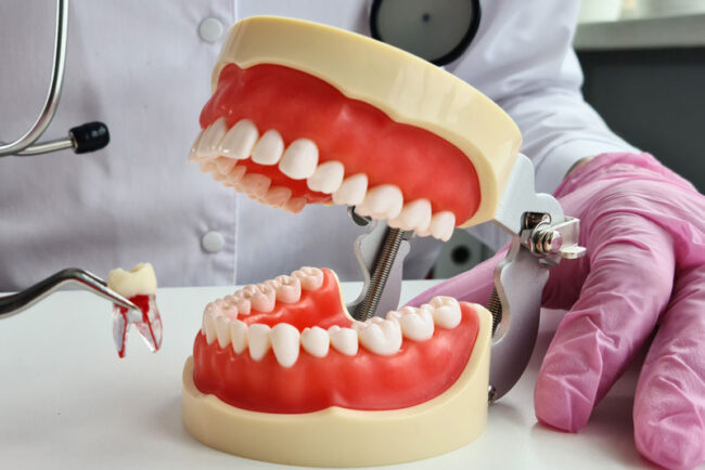 a-full-mouth-model-single-tooth-extraction a full mouth model showcasing a single tooth extraction.