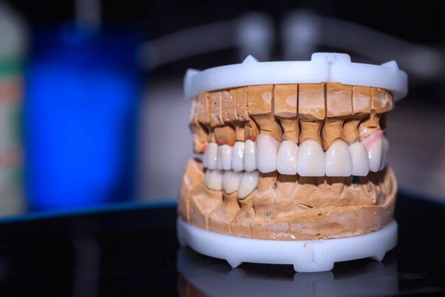 full-arch-implant-model a full mouth dental implant model with dental crowns and a dental bridge.