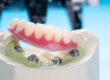 an implant supported denture model all on four implant posts.