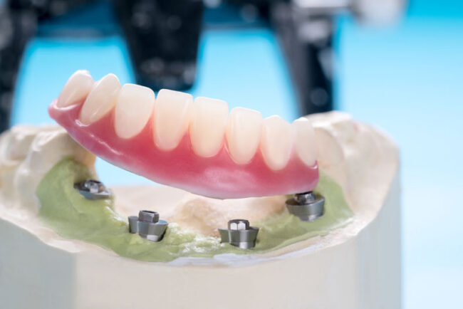 an-implant-supported-denture-model-all-on-four-implant-posts an implant supported denture model all on four implant posts.