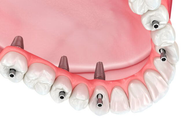 dental-implant-prosthetic-being-placed-on-dental-implant-posts dental implant prosthetic being placed on dental implant posts.
