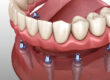 a digital model of a lower arch after an implant supported denture procedure.