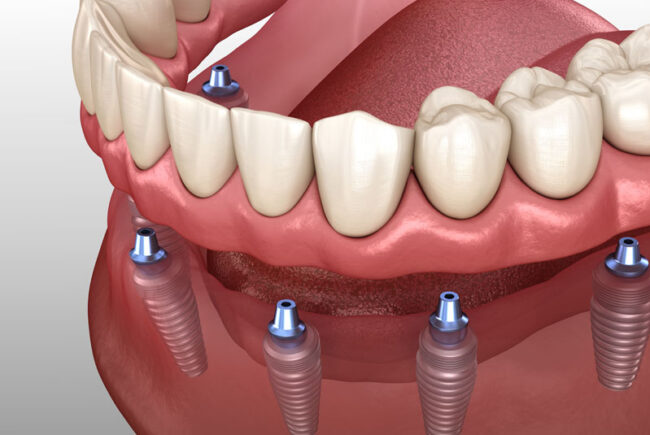 implant-supported-dentures-graphic a digital model of a lower arch after an implant supported denture procedure.