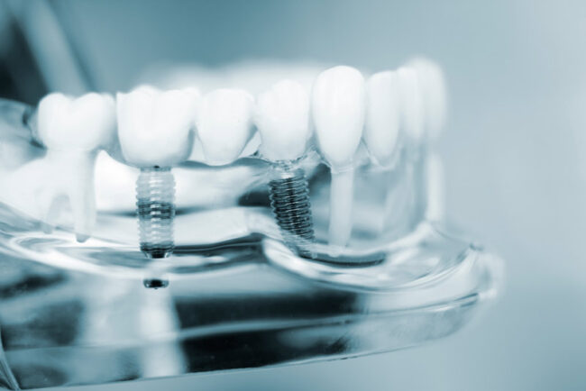 multiple-dental-implant-model A model showing dental implants.