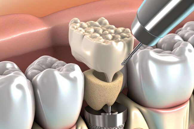 3d image of a dental implant model of a bone grafting and dental implant procedure.