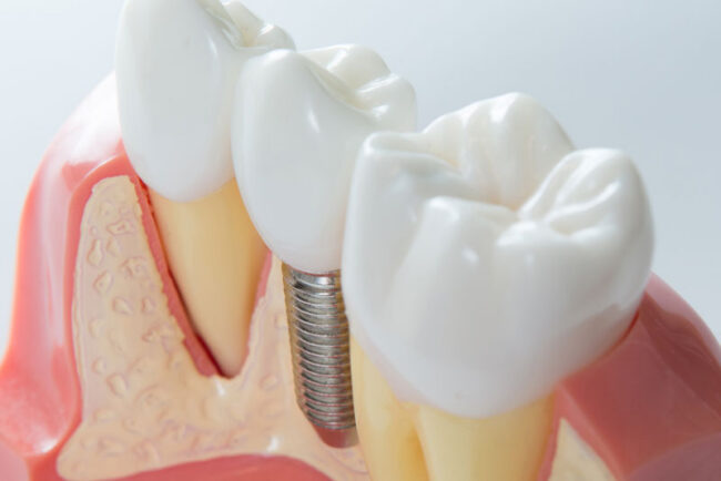 dental-implant-post-digital-model a digital model of a dental implant post and crown.