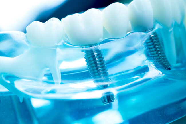 dentalimplants2 Close-up 3d image of a dental implant