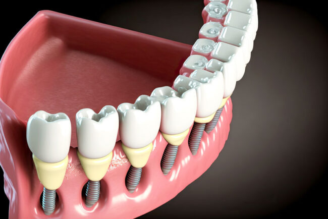 full-mouth-implants Close-up 3d model of a dental implant