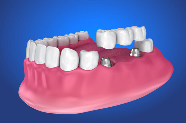 3d image of a dental implant bridge and a prosthesis jaw with a blue backdrop 3d image of a dental implant bridge and a prosthesis jaw with a blue backdrop
