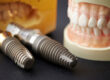 demonstrating the placement of a dental implant on a close up, Ai generated image.