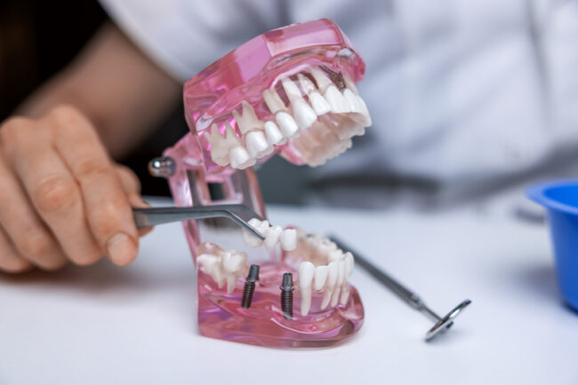 implants2 dentist implantologist showing dental bridge implant technology on human tooth jaw model.