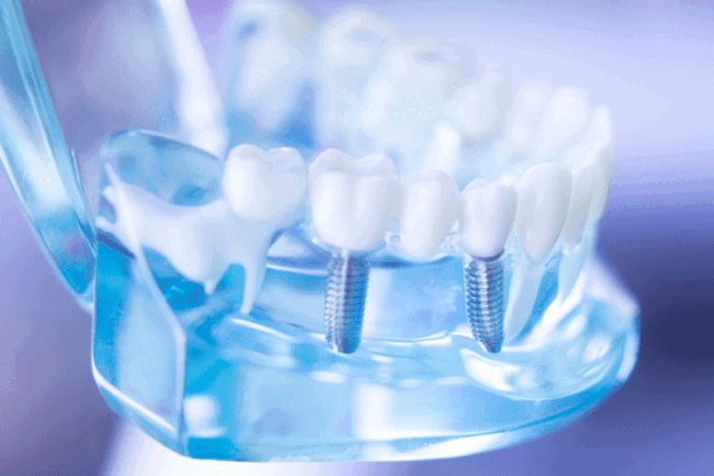 imp1 Dentist clear jaw model, dental tooth implant