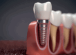 Medically accurate 3D illustration of human teeth and Implant concept